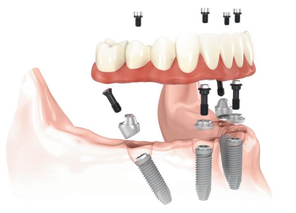 Full Arch with Only Four Implants graphic