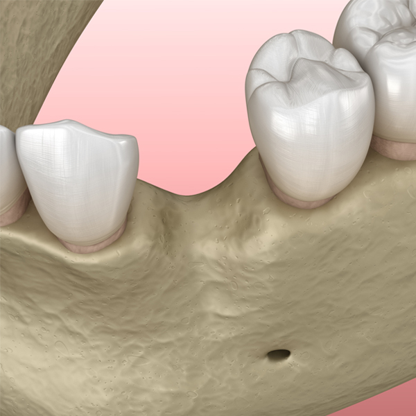 Bone Grafting 1