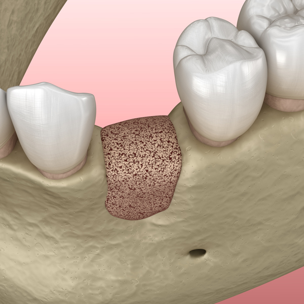 Bone Grafting 2