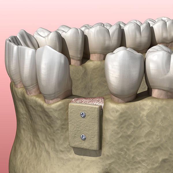 Bone Grafting 3