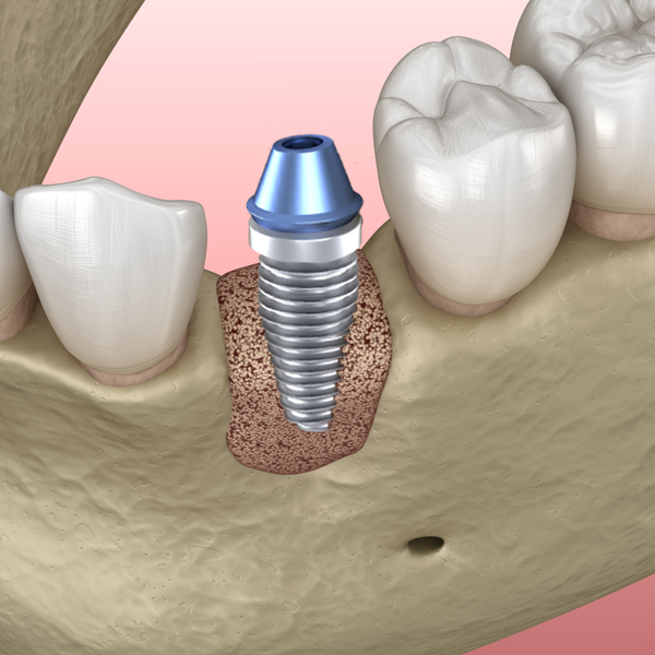 Bone Grafting 4