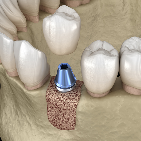 Bone Grafting 5