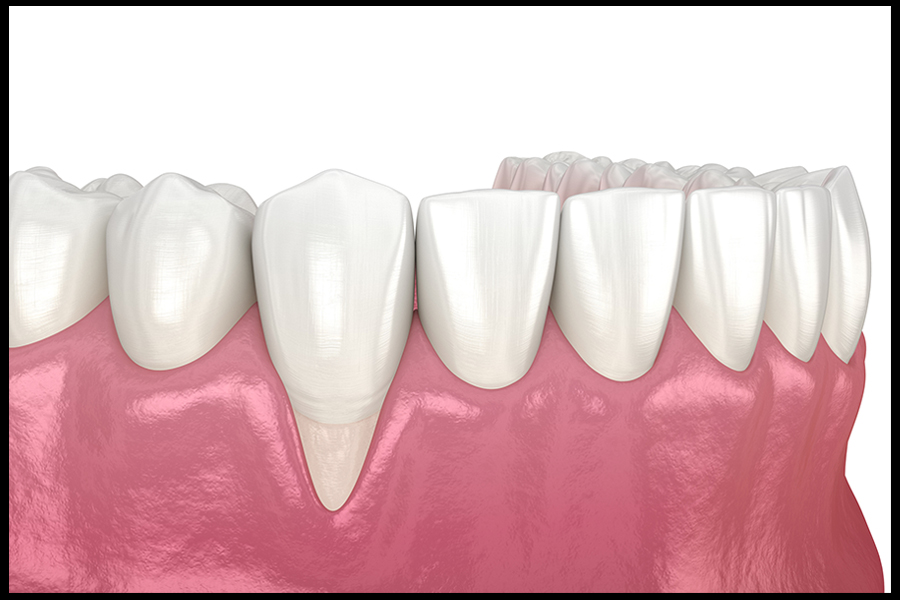 Gum Graft Image 1