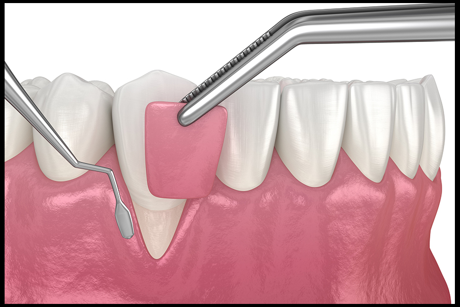 Gum Graft Image 2