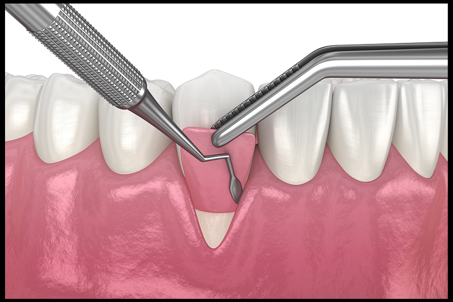 Gum Graft Image 3