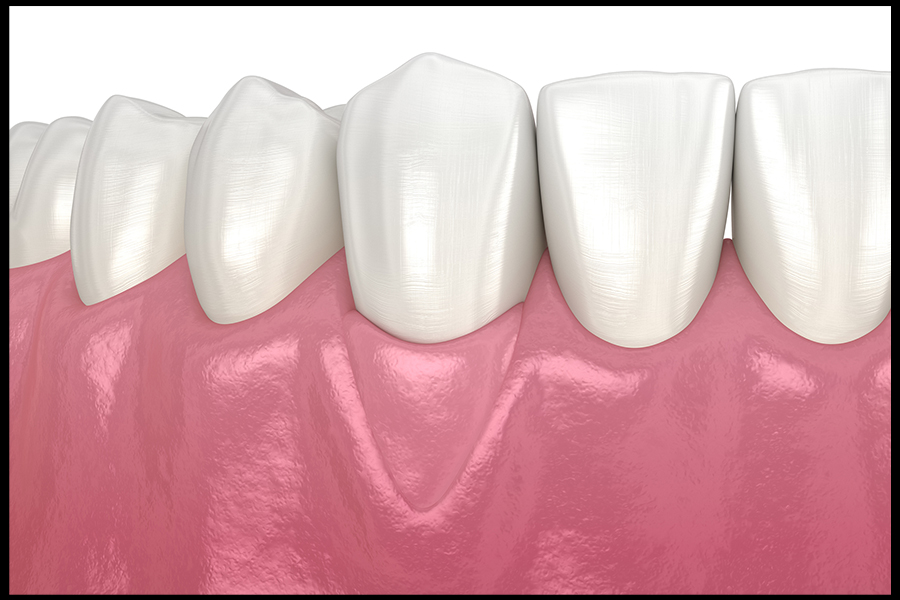 Gum Graft Image 4