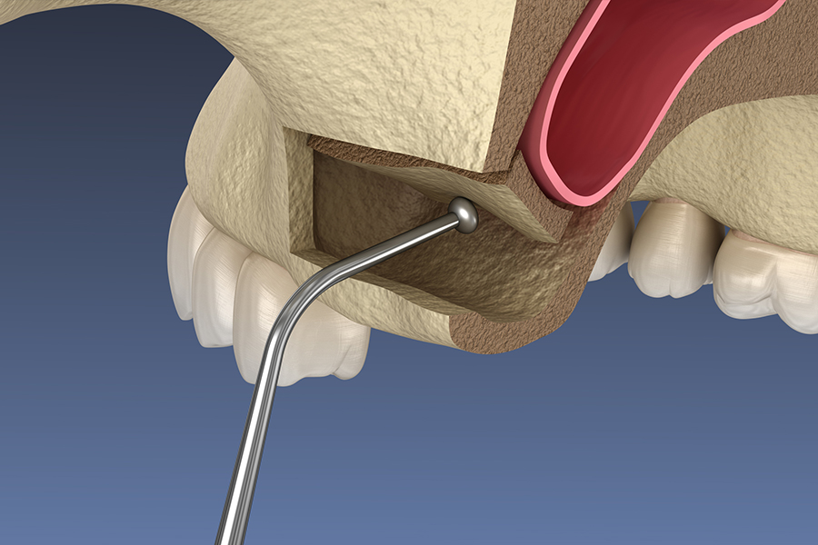 Sinus Lift Photo 2