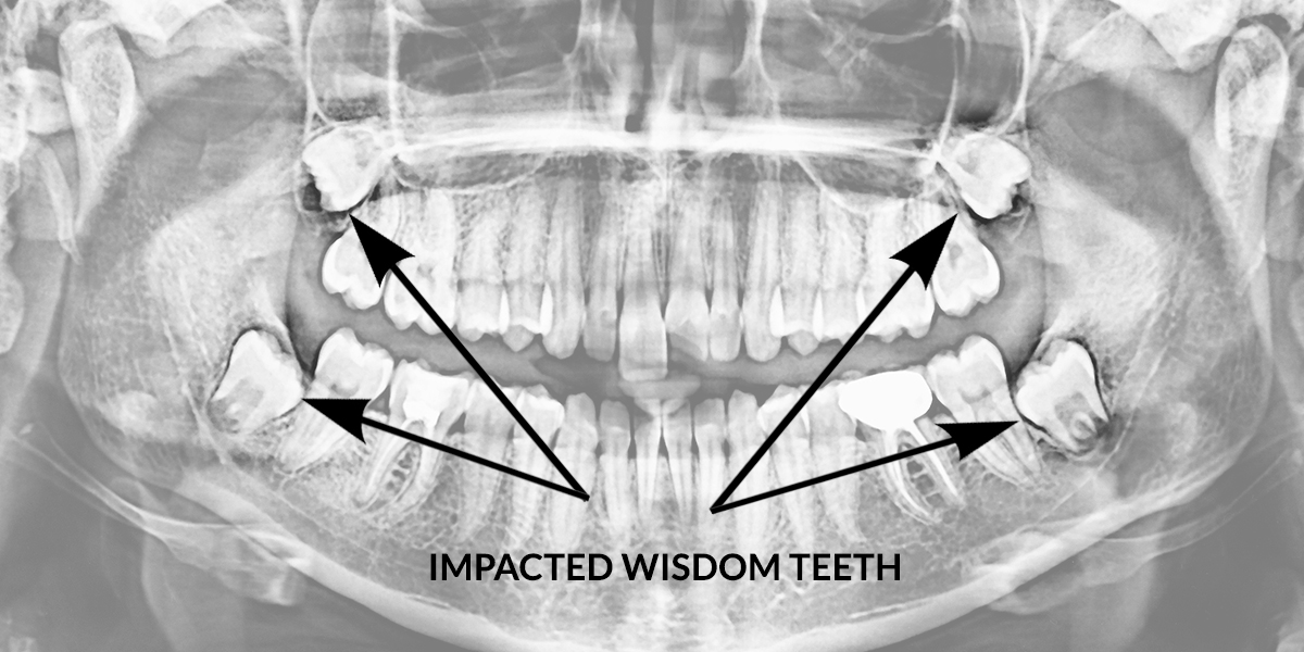 xray showing impacted wisdom teeth