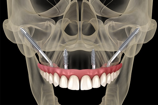 Single Tooth Dental Implants illustration